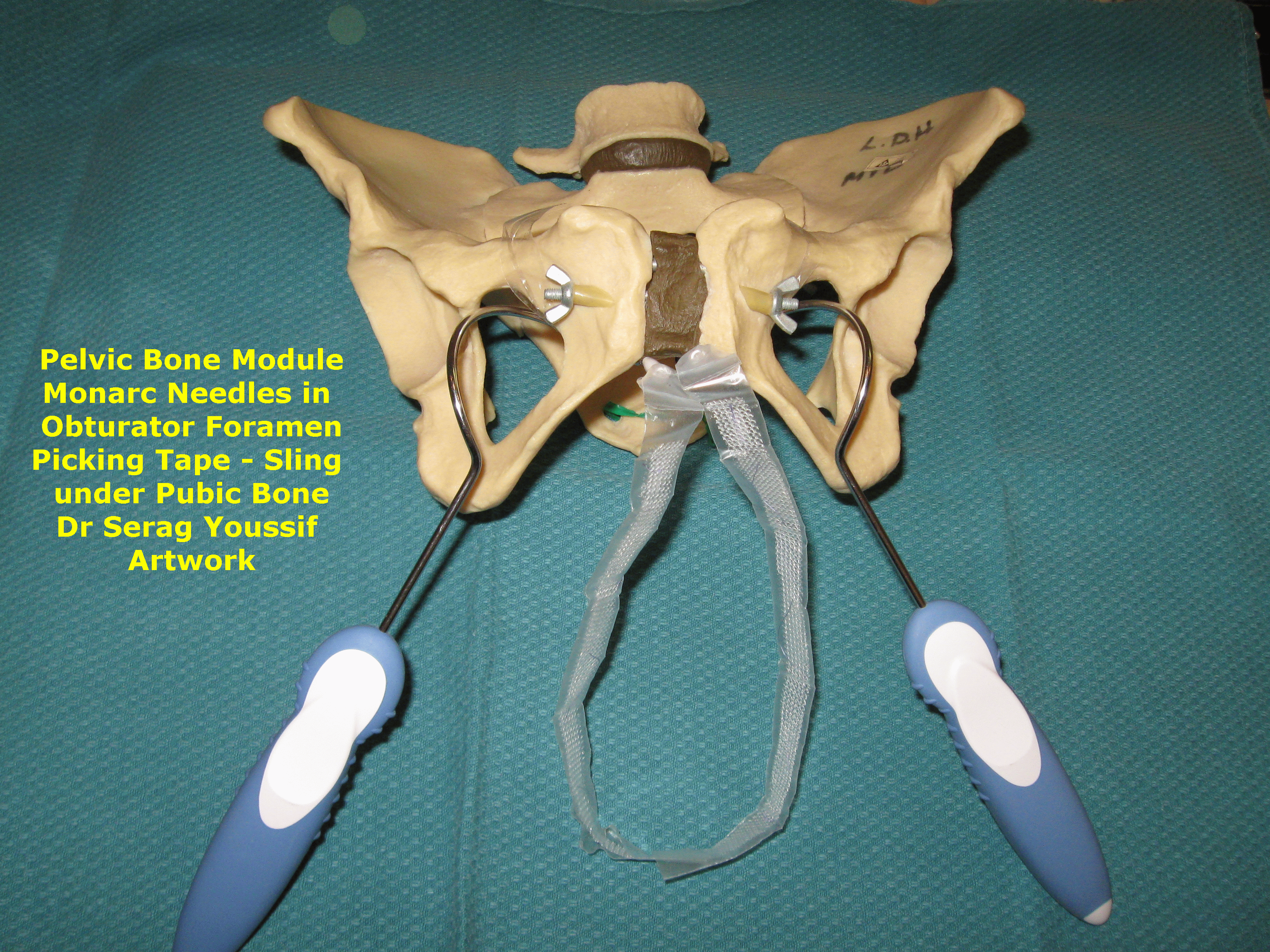 Monarc  Needles and Sling Tape Obturator Foramen Serag Youssif1